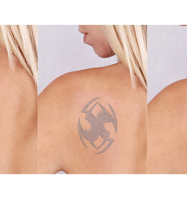 epila-nazilli-dovme-silme-1